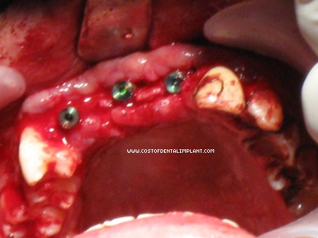 Three implant fixtures for a four unit freestanding fixed partial denture