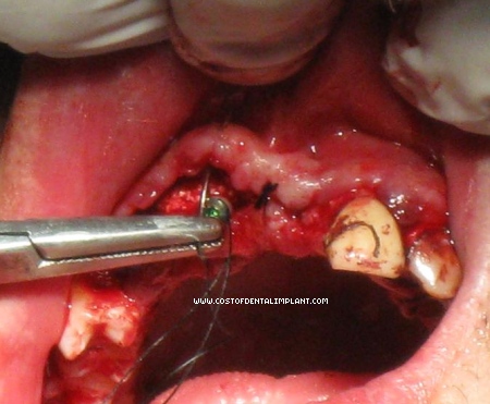 Suture Technique on Dental Implant and Bony Defect with GTR