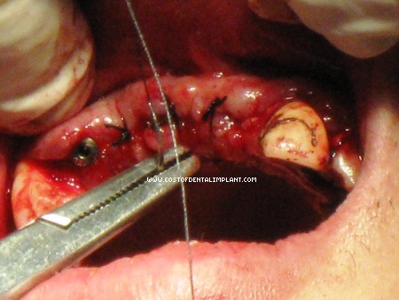 Dental Implant Closure, third dental implant is still visible (mesial to 14)