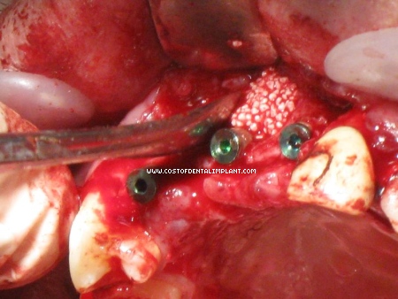 Resorbable Tissue Replacement (RTR) placed labial to Dental Implant