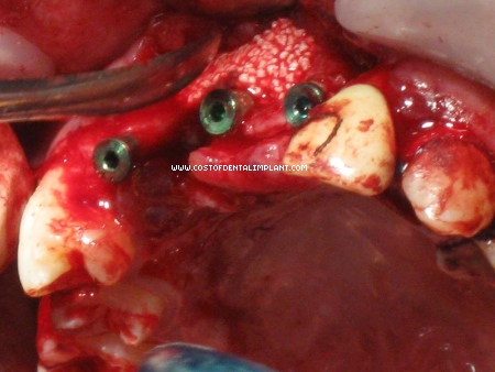 Resorbable Tissue Replacement (RTR) mixed with patient's blood