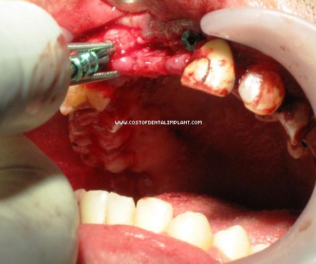 Dental Implant is being inserted mesial to 14 - FDI Two-Digit Notation, upper right first premolar.