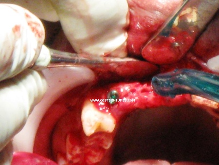 Bony defect near the site for the middle implant body