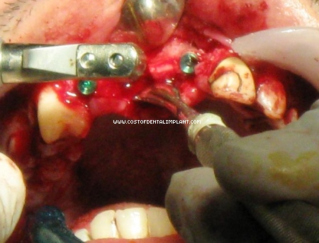 Drilling procedure done on implant site.
