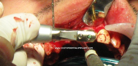 Drilling Procedure