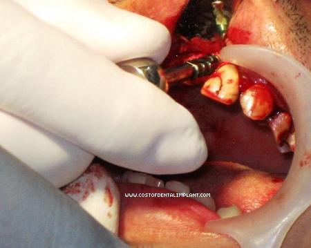Implant was placed mesial to tooth number 22 (FDI Two-Digit Notation).