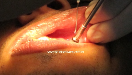 Mini Dental Implants