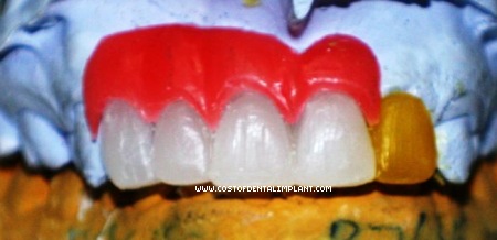 Wax-up of Implant Supported Prosthesis