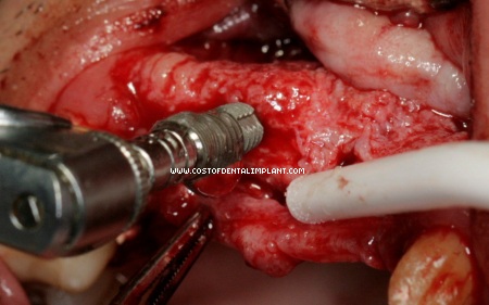 The tapping procedure for threading and fixture installation into bone requires a drilling speed between 15-20 r.p.m. - costofdentalimplant.com