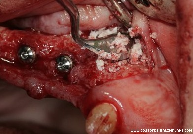 Bone Graft Procedure