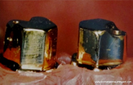 Dental Implants: Inner Coping