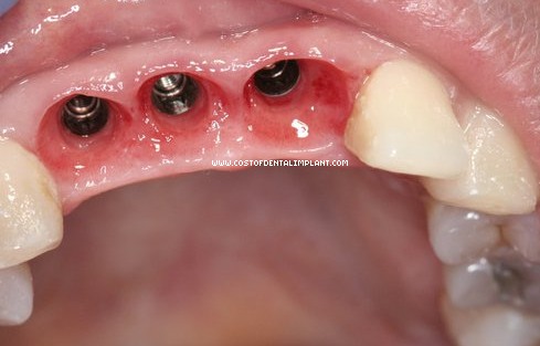 Three Dental Implant fixtures