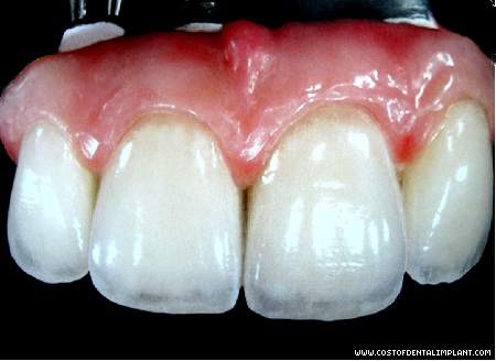 Fully implant supported Fixed Bridge with prosthetic gingiva