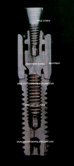 Parts of a Dental Implant