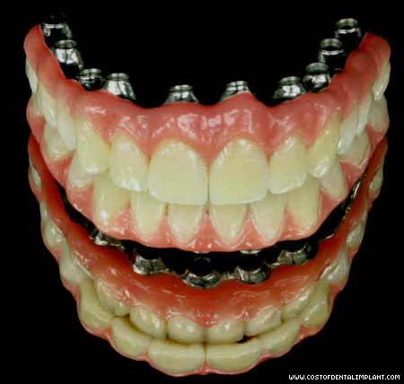 Implant Supported Fixed Bridges
