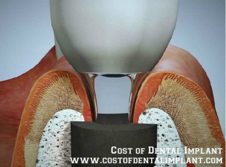 Health Status for Dental Implants - costofdentalimplant.com