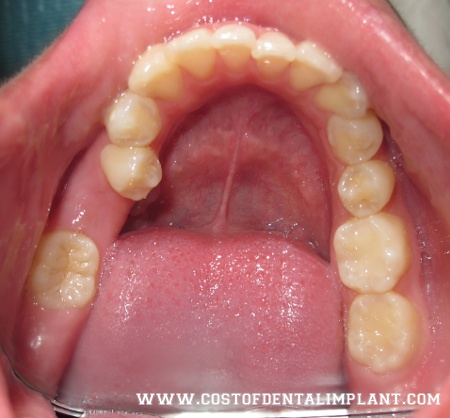 Evaluate soft tissue condition for health of periodontium and pathology, location of alveolar and attached mucosa. - costofdentalimplant.com