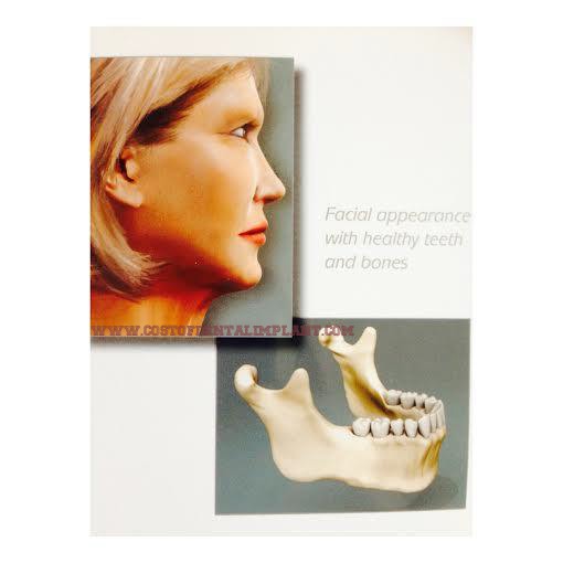 Facial appearance with healthy teeth and bones. - www.costofdentalimplant.com