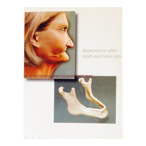 Appearance after tooth and bone loss. - www.costofdentalimplant.com