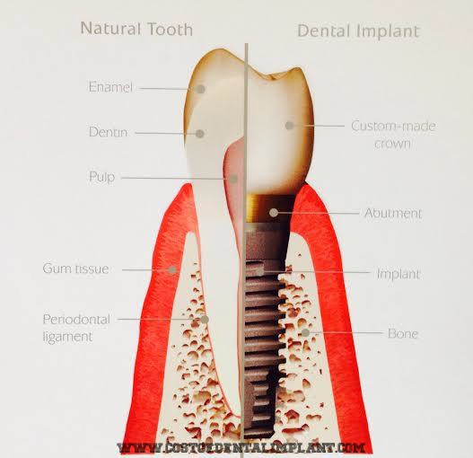 Natural tooth vs. dental implants. - www.costofdentalimplant.com